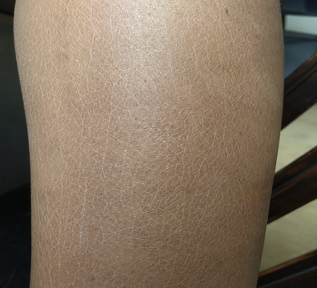 Dry Inflamed Skin