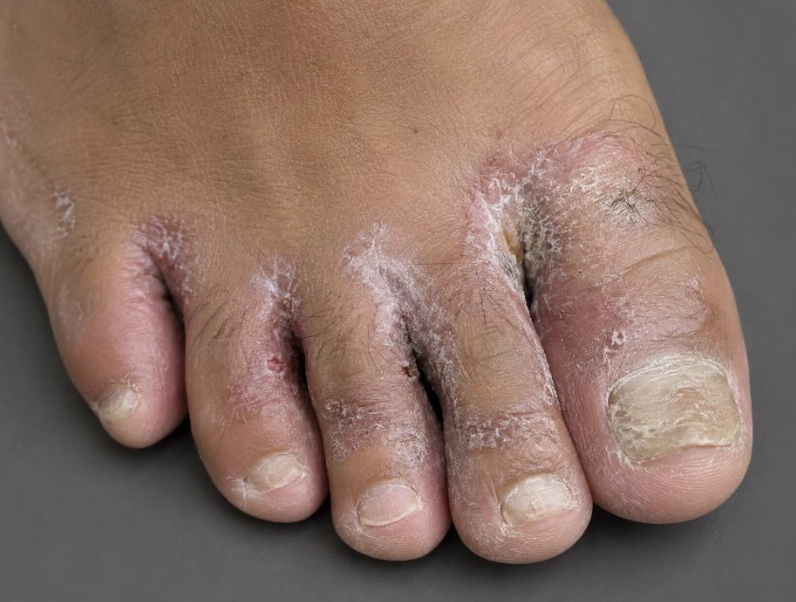Fungal Infection