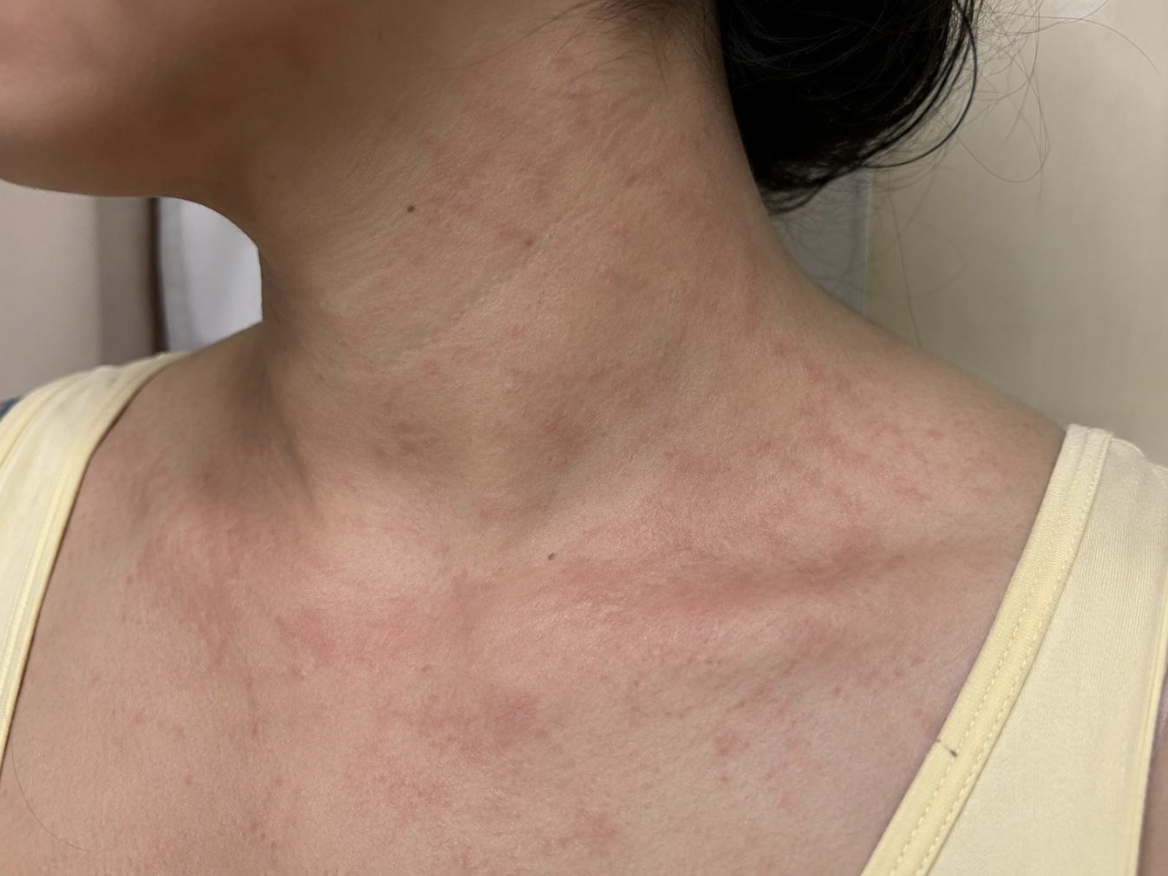 Red Rashes or Patches