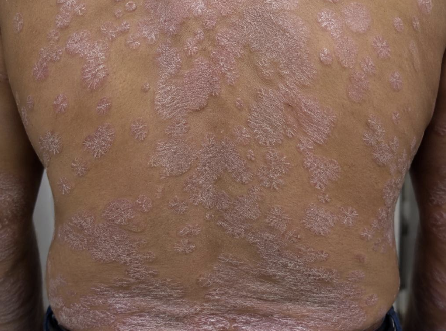 Thick, Itchy Skin Patches