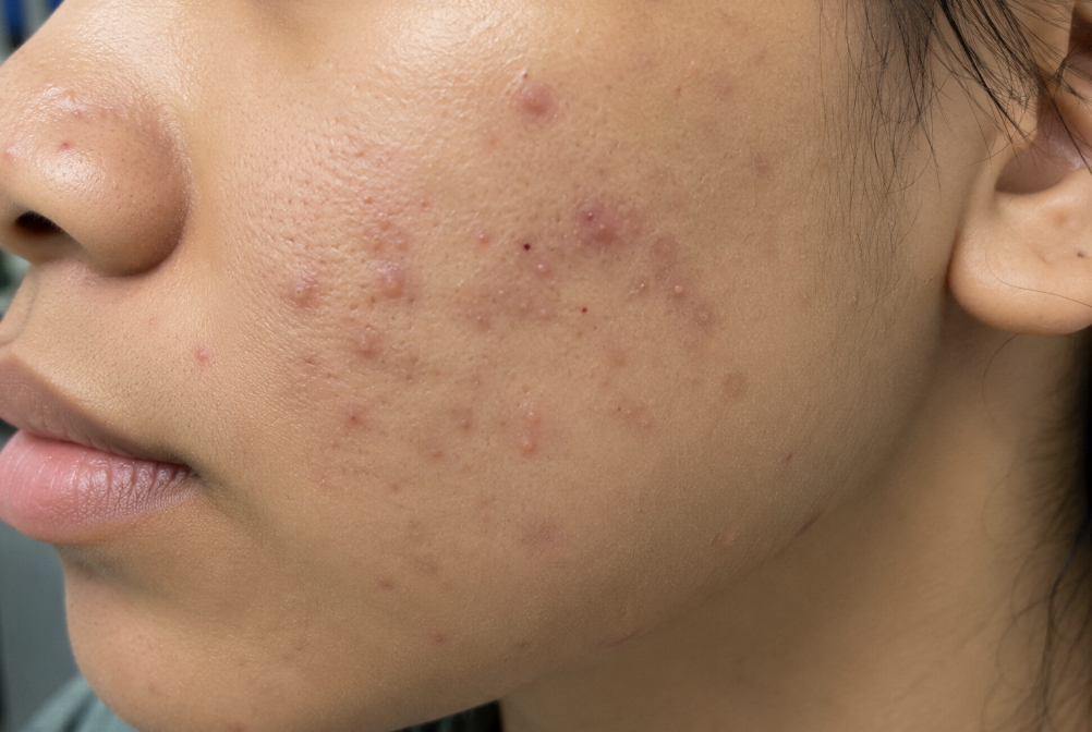 Frequent pimples