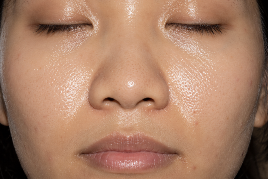 Oily skin