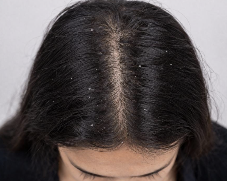 Dandruff with Hair Fall