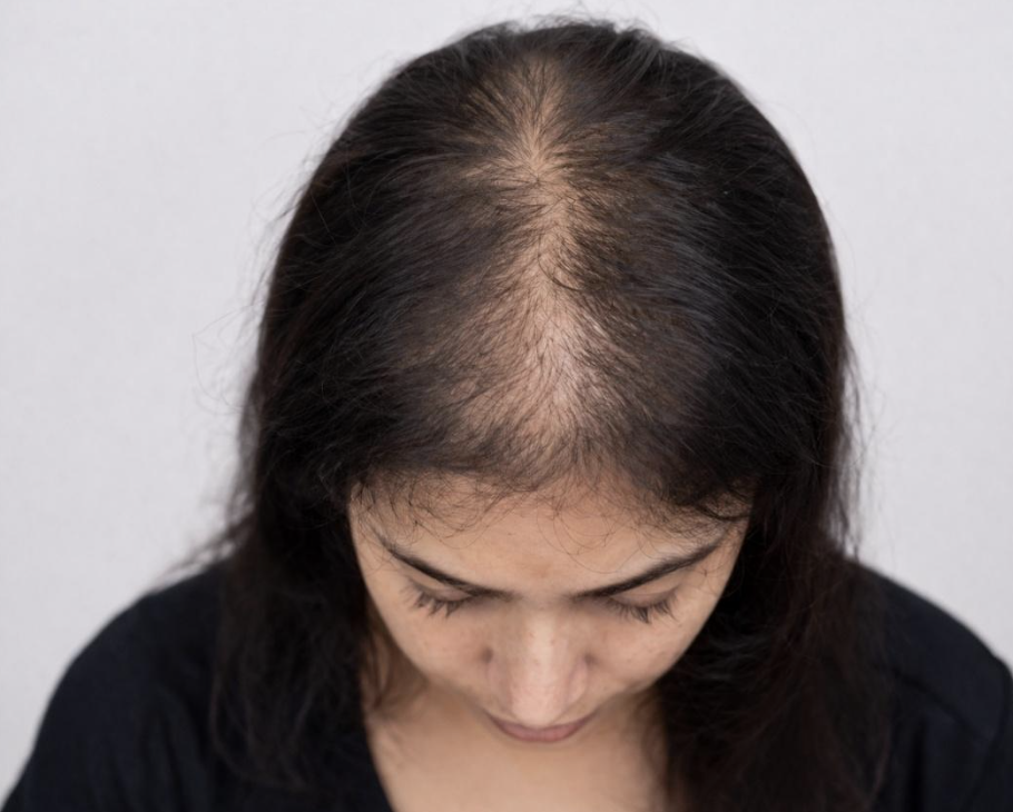 Hair Thinning
