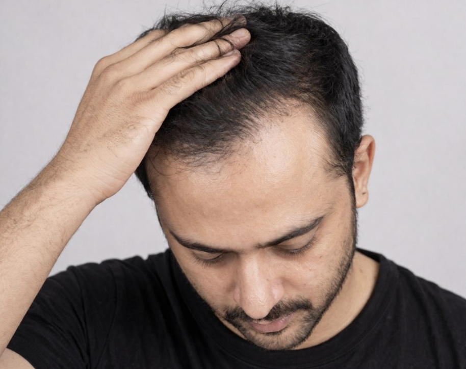 Receding Hairline