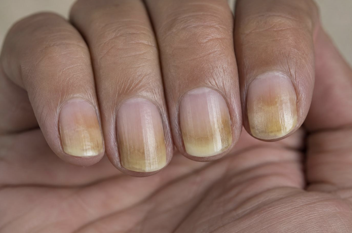 Changes in Nail Color