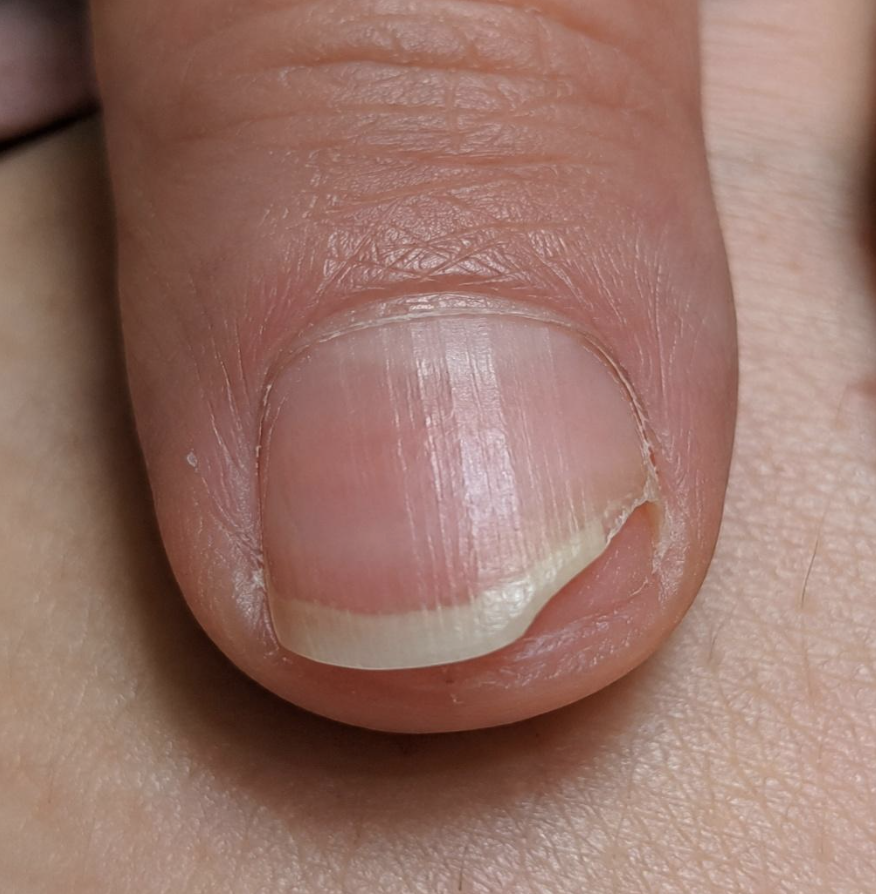 Nail Lifting from Skin