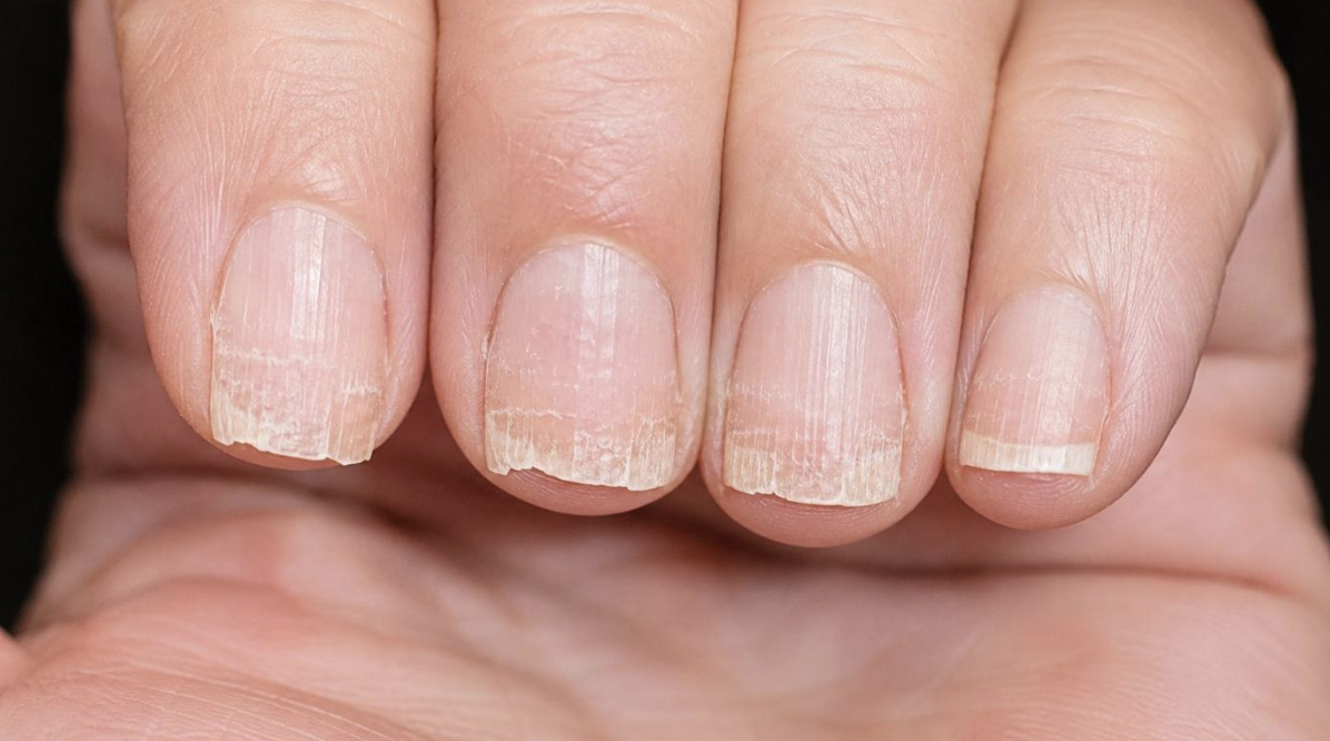 Weak, Fragile Nails