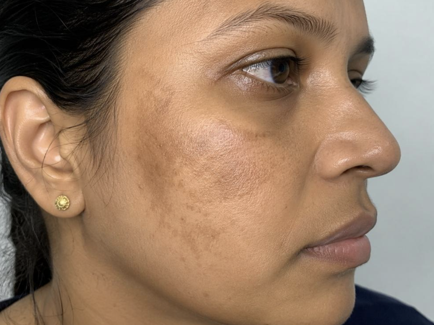 Melasma & Patchy Pigmentation