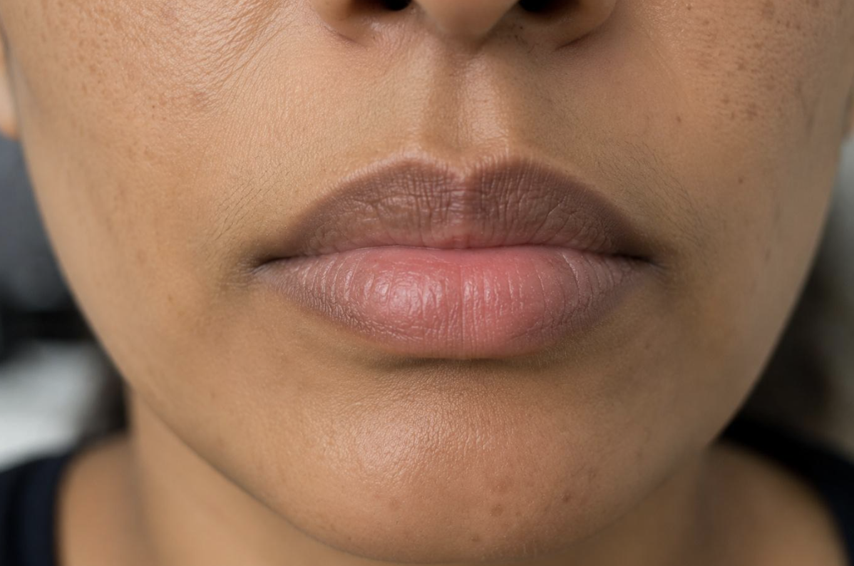 Uneven Skin Tone